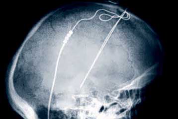 Εμφυτεύματα στον εγκέφαλο τώρα και για την ιδεοψυχαναγκαστική διαταραχή