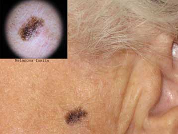 Δωρεάν δερματολογική εξέταση από την ΕΔΑΕ για την πρόληψη του μελανώματος