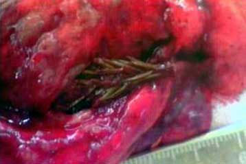 Έλατο «φύτρωσε μέσα στους πνεύμονες ασθενή»