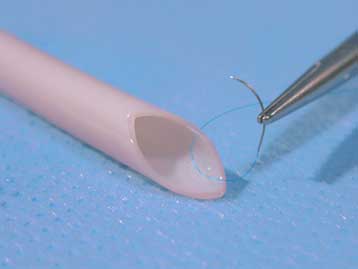 Αιμοφόρα αγγεία καλλιεργούνται από κύτταρα ασθενών