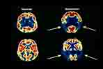 Ένζυμα σχετίζουν τα εγκεφαλικά τραύματα με τη νόσο Αλτσχάιμερ