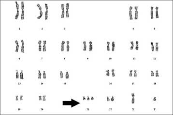 Γιατί τα άτομα με σύνδρομο Down δεν παθαίνουν καρκίνο