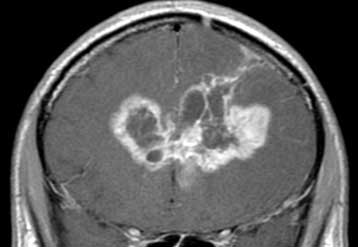 Τα πρώτα γονίδια που σχετίζονται με τους συνηθέστερους όγκους στον εγκέφαλο