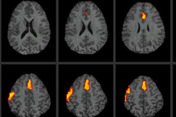 Οι παχύσαρκοι «παρουσιάζουν σοβαρή εκφύλιση του εγκεφάλου»