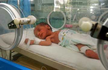 Απομονώθηκε πρωτεΐνη που προκαλεί τις πρόωρες γεννήσεις