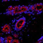 Εντοπίστηκαν οι «ένοχοι» επιθετικής μορφής καρκίνου του μαστού