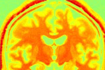 Τρία ακόμα γονίδια εμπλέκονται στη νόσο του Αλτσχάιμερ