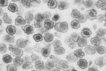 Ιός ενοχοποιείται για ορισμένους καρκίνους του προστάτη