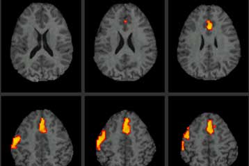 Η φαιά ουσία «δεν συρρικνώνεται στους υγιείς ηλικιωμένους»