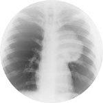 Νανοσωματίδια χρυσού ανιχνεύουν τον καρκίνο του πνεύμονα σε πρώιμα στάδια