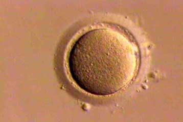 Πρώτη γέννηση με τη βοήθεια νέας τεχνικής ελέγχου των ωαρίων