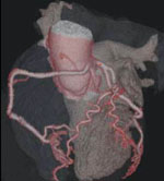 Οξέα Στεφανιαία Σύνδρομα: Τί τα προκαλεί και πώς αντιμετωπίζονται;