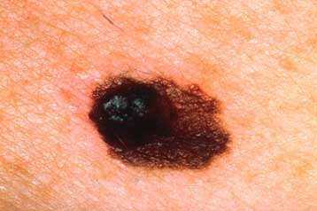 Πειραματικό φάρμακο προσφέρει ελπίδα κατά του μελανώματος