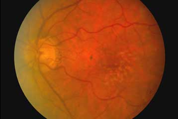 Βλαστικά κύτταρα καθυστερούν την τύφλωση σε πειραματόζωα