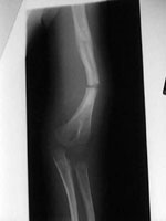 H διατατική οστεογένεση δίνει λύση στο πρόβλημα του νανισμού