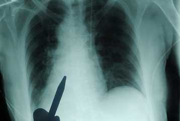 Βλαστικά κύτταρα δοκιμάζονται κατά της πνευμονικής ίνωσης στην Αλεξανδρούπολη