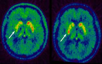Πέντε γονίδια προδιαθέτουν για Πάρκινσον σε μερίδα του πληθυσμού