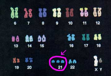 Έρευνα σε ποντίκια δημιουργεί αισιοδοξία κατά του συνδρόμου Down