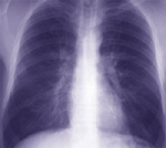 Πρωτοποριακές θεραπείες βελτιώνουν το βρογχικό άσθμα