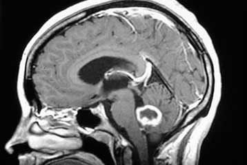 Γονίδια εκτός ελέγχου κρύβονταν πίσω από θανατηφόρο καρκίνο του εγκεφάλου