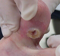 Τα διαβητικά έλκη κάτω άκρων συντελούν σε πρόωρο θάνατο