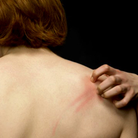 Ψυχολογικά επιβαρυντικός είναι ο χρόνιος δερματικός κνησμός