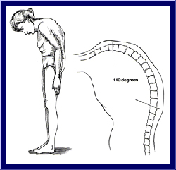 Ανακαλύφθηκαν δύο γονίδια που εμπλέκονται στην αγκυλοποιητική σπονδυλίτιδα