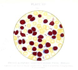 Τέσσερις νέες γενετικές μεταλλάξεις αυξάνουν τον κίνδυνο χρόνιας λεμφοκυτταρικής λευχαιμίας