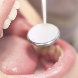 Το πλάσμα στην αποκατάσταση των οδοντιατρικών προβλημάτων