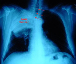 Διαφορετική η φύση του καρκίνου των πνευμόνων στις γυναίκες