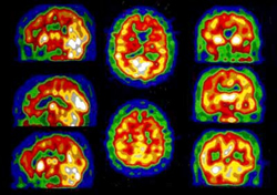 Ανακαλύφθηκε γονίδιο που επιταχύνει την μετωποκροταφική άνοια