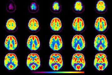 Τομογραφία για τη νόσο του Αλτσχάιμερ «εντοπίζει τα άτομα υψηλού ρίσκου»