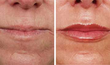 Νέα πλαστική επέμβαση στα χείλη χρησιμοποιεί μοσχεύματα από το λαιμό
