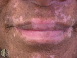 Αποτελεσματική η μεταμόσχευση δέρματος στην θεραπεία της λεύκης