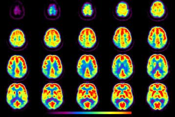 Τομογραφία για τη νόσο του Αλτσχάιμερ «εντοπίζει τα άτομα υψηλού ρίσκου»