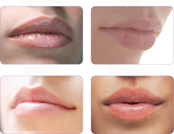 Φυσικό εμφύτευμα υπόσχεται καλύτερη ανάπλαση των χειλιών