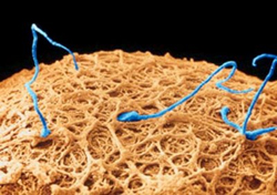 Κίνδυνος καρκίνου του προστάτη για τους άνδρες με προβλήματα γονιμότητας