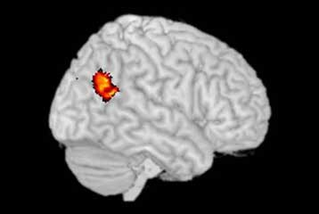 Ηλεκτρική διέγερση του εγκεφάλου παρεμβαίνει στις ηθικές κρίσεις
