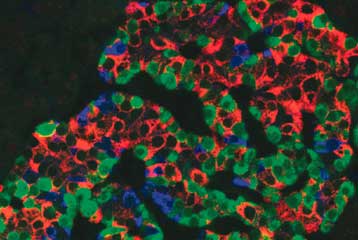 Ένα βήμα πιο κοντά το τεχνητό πάγκρεας για διαβητικούς