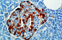 Τεχνητό πάγκρεας δημιουργεί ελπίδες καλύτερης διαχείρισης του διαβήτη