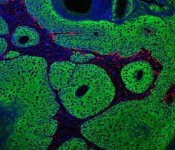 Γονιδιακή θεραπεία πετυχαίνει την εξαφάνιση καρκινικών δερματικών όγκων