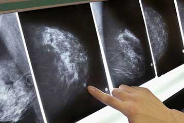 Νέοι γενετικοί παράγοντες αναγνωρίστηκαν στον καρκίνο του μαστού