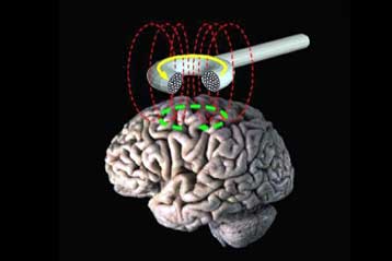Επιβεβαιώνεται η αποτελεσματικότητα της μαγνητικής θεραπείας για την κατάθλιψη