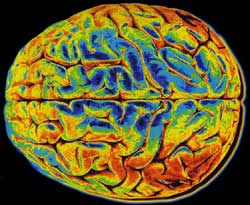 Βρέθηκαν δύο νέα γονίδια που σχετίζονται με τη νόσο Αλτσχάιμερ