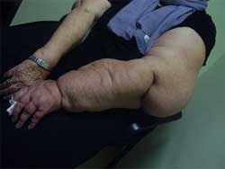 Το λεμφοίδημα υποβαθμίζει δραματικά την ζωή των ασθενών