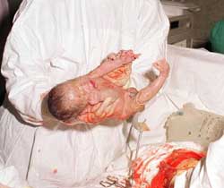 Γενετικό υπόβαθρο ίσως έχει ο πρόωρος τοκετός