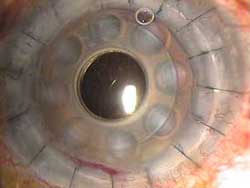 Τεχνητό κερατοειδή που θα χρησιμοποιηθεί για μεταμοσχεύσεις δημιουργούν οι επιστήμονες