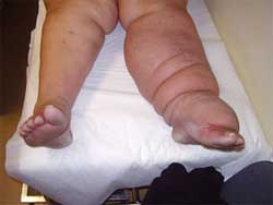 Λεμφοίδημα: Ο άγνωστος εχθρός