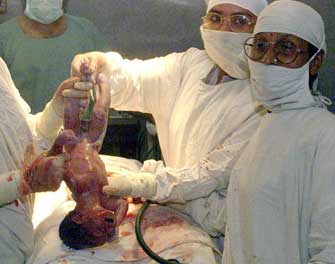 Συχνότερες οι επιπλοκές όταν ο τοκετός συμβαίνει νύχτα