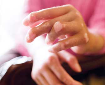 Σκληρόδερμα: Έγκαιρη διάγνωση για καλύτερη ποιότητα ζωής